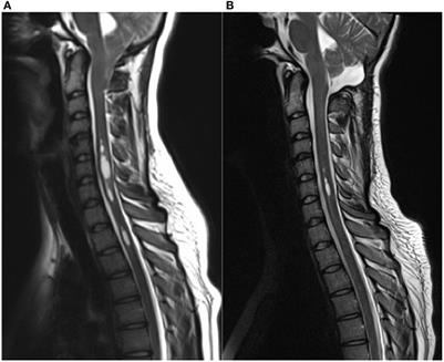 Decompression in Chiari Malformation: Clinical, Ocular Motor, Cerebellar, and Vestibular Outcome